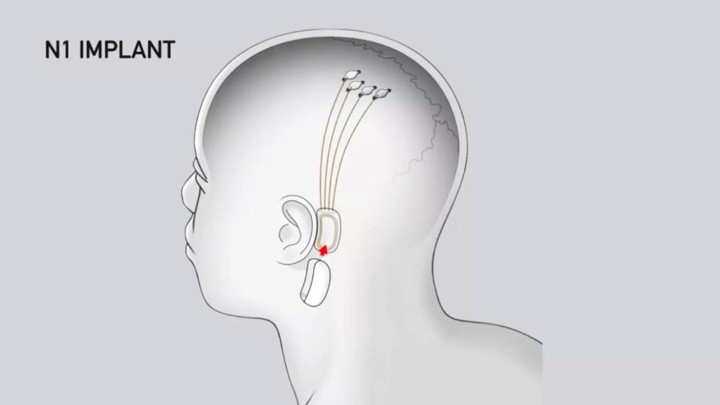 Neuralink guide: How wearables will play their part in Elon Musk's brain tech
