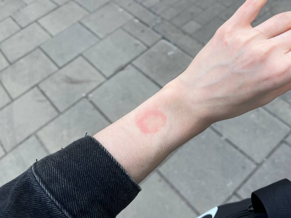 Irritation caused by Apple Watch