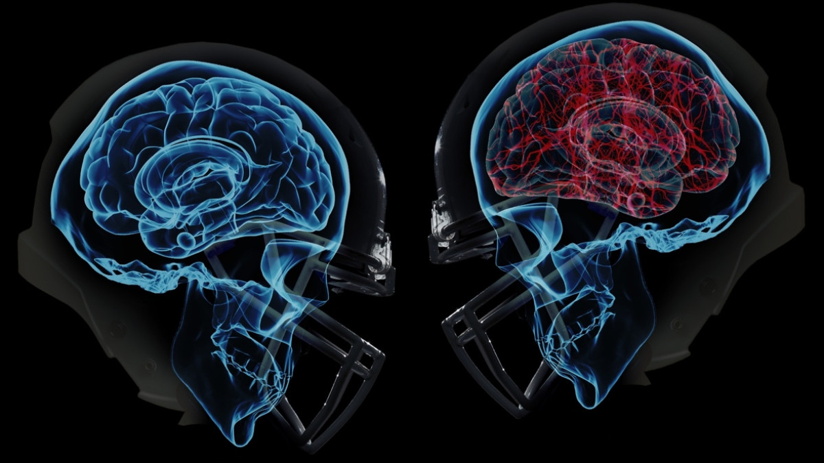 Both on and off the field, wearables are taking on the NFL's concussion crisis