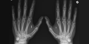 US presidential candidate gets RFID/NFC chip implanted in his hand